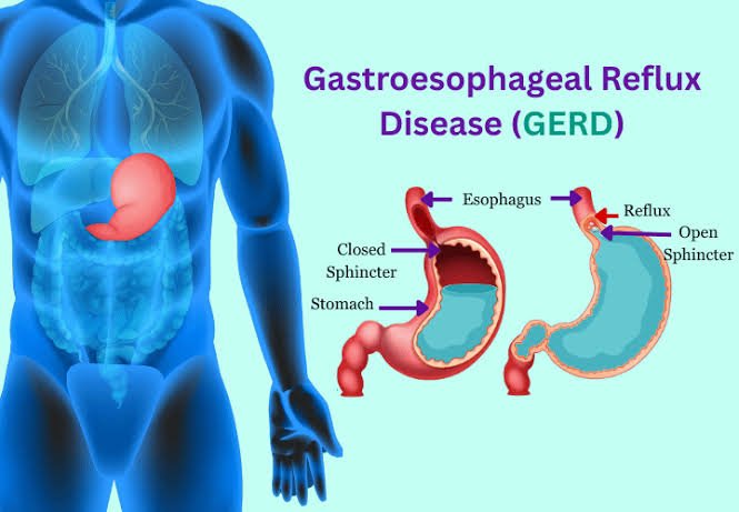 Gastroesophageal Reflux Disease (GERD)